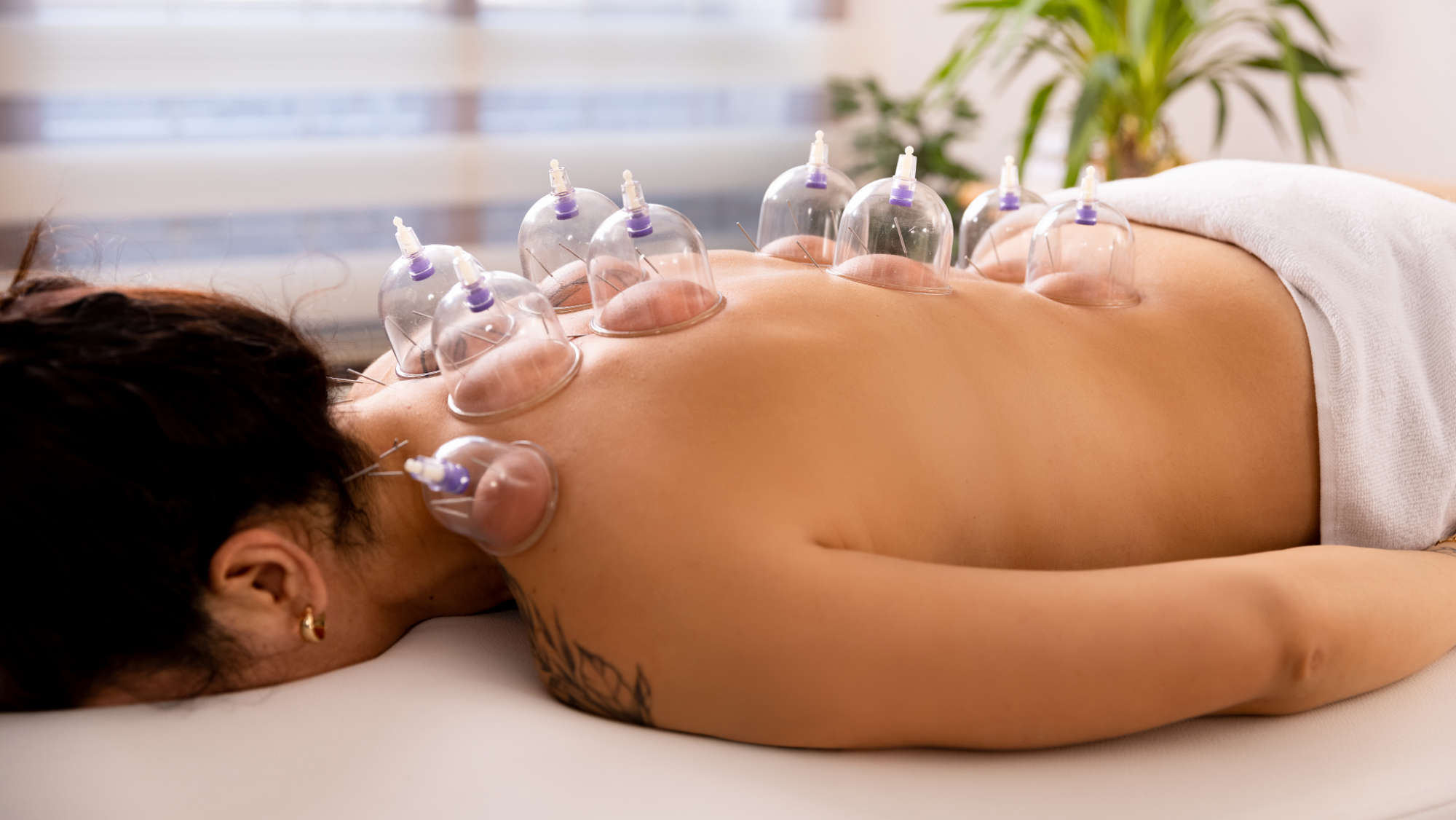 Cupping Aftercare